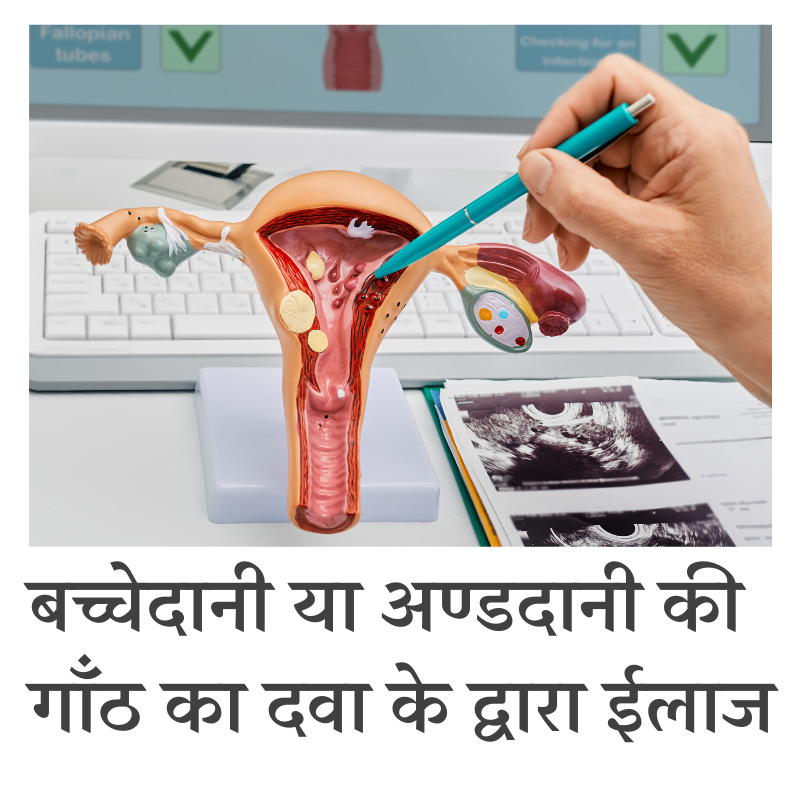 बच्चेदानी और अंडदानी की गांठ का दवा से इलाज
